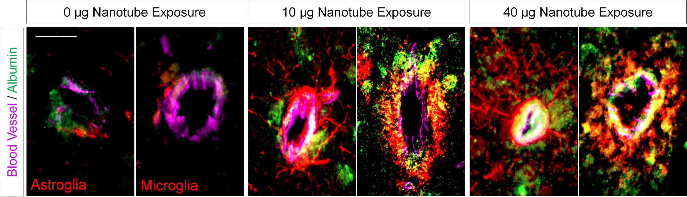 Pictured is the induced leakage of the blood-brain barrier and the consequential neuroinflammatory activation of the glial cells in brains exposed to varying amounts — from 0 to 40 micrograms (µg) — of nanotubes released into the lungs. Serum albumin (green) is shown having leaked from the blood vessels (purple) into the brain. At top, astroglia (red) react by forming a scar-like barrier around the leaking vessel, controlling further leakage. At bottom, microglia (red) — a hallmark of neuroinflammation — are also activated and recruited to the leaking vessels where they are cleaning up the leaked albumin. As the nanotube exposure is increased, more albumin leaks and a greater number of glial cells become active, extending further out from the vessel and impacting more brain tissue.  