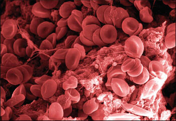 This highly magnified image shows WoundStat interacting with whole blood after one minute. The formation of fibrin – clotting – can be seen. Image Courtesy VCURES.