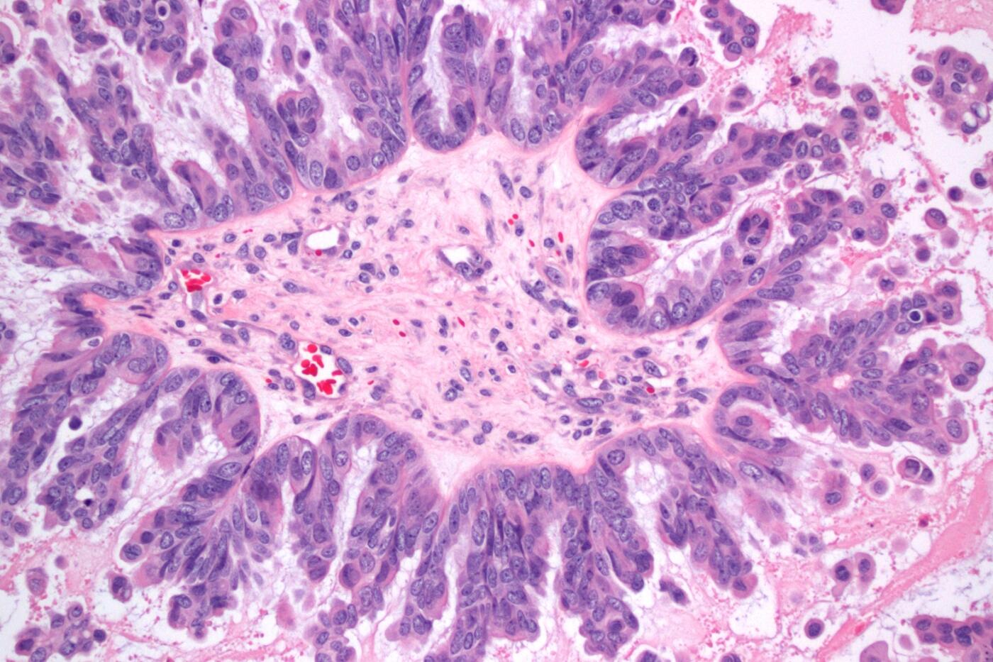 <p style="text-align: left;"><span style="font-family: sans-serif; font-size: large;"><strong>“A Serous Borderline Ovarian Tumor With Micropapillary Features”<br /></strong></span><em>Ema Dragoescu, M.D., assistant professor, </em><em><a href="http://www.pathology.vcu.edu/index.html" target="_blank"><span style="color: blue; font-family: calibri;"><span style="text-decoration: underline;">Department of Pathology</span></span></a><span style="font-family: calibri;">, School of Medicine</span></em></p>
<p style="text-align: left;"><span style="font-family: calibri;">This image is of a hematoxylin eosin-stained section of an ovarian tumor at 200-times magnification. The cells surrounding the central core form thin, filiform micropapillae – an arrangement known as the “Medusa head” – that indicate aggressive behavior in the tumor.</span>