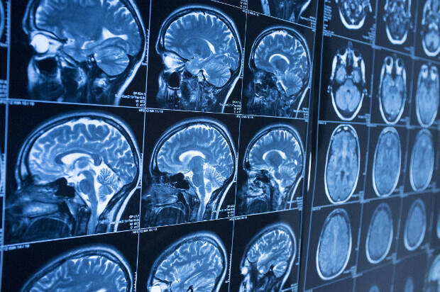 A series of brain scans.