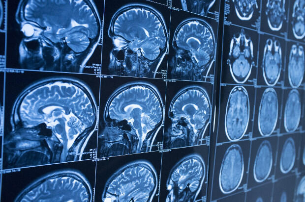 A series of brain scans.