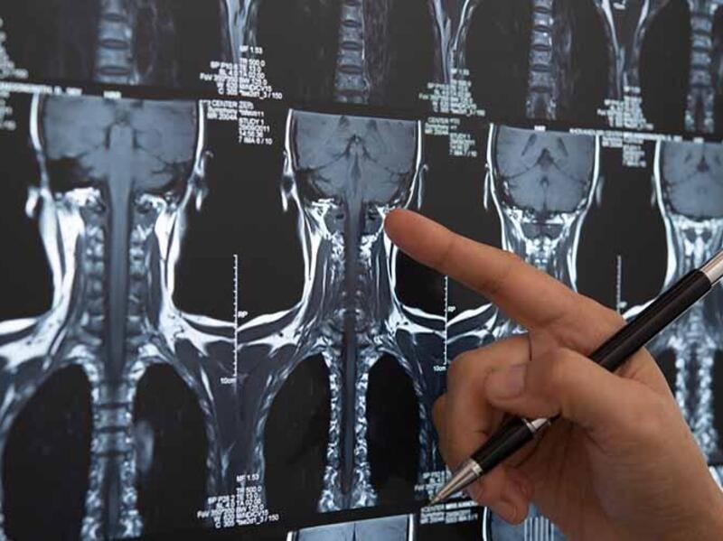 Doctor looking at X-Rays of spine