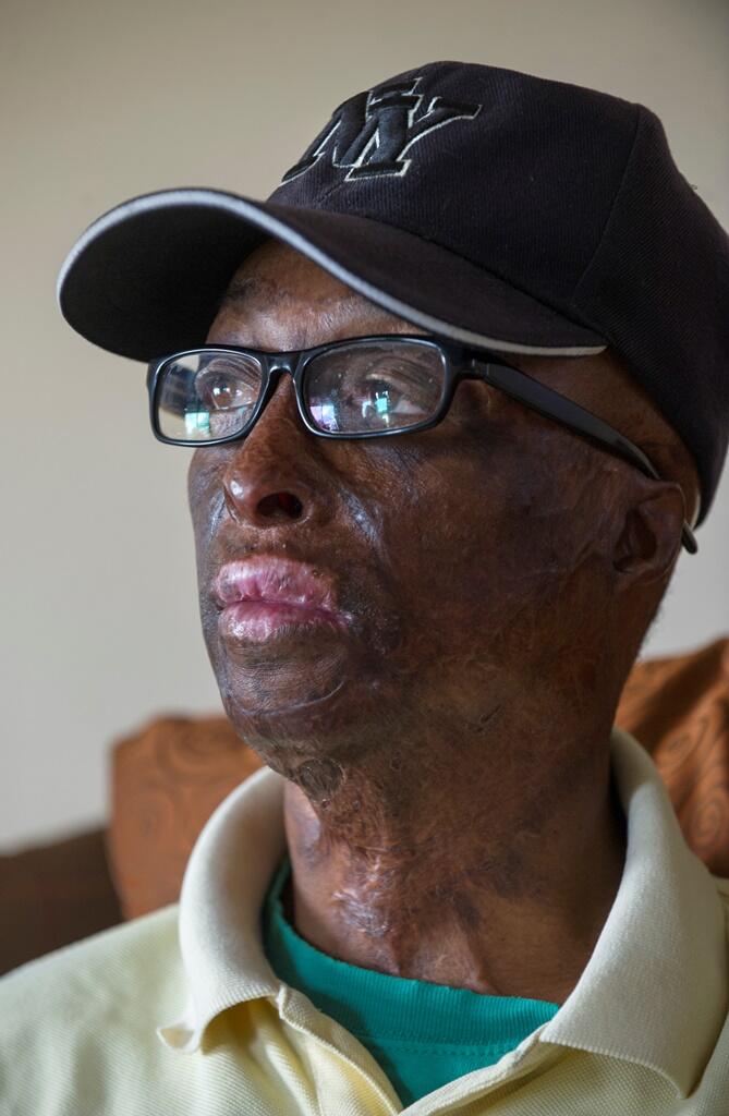 Terry Langhorne suffered fourth-degree burns to his face and upper body. 