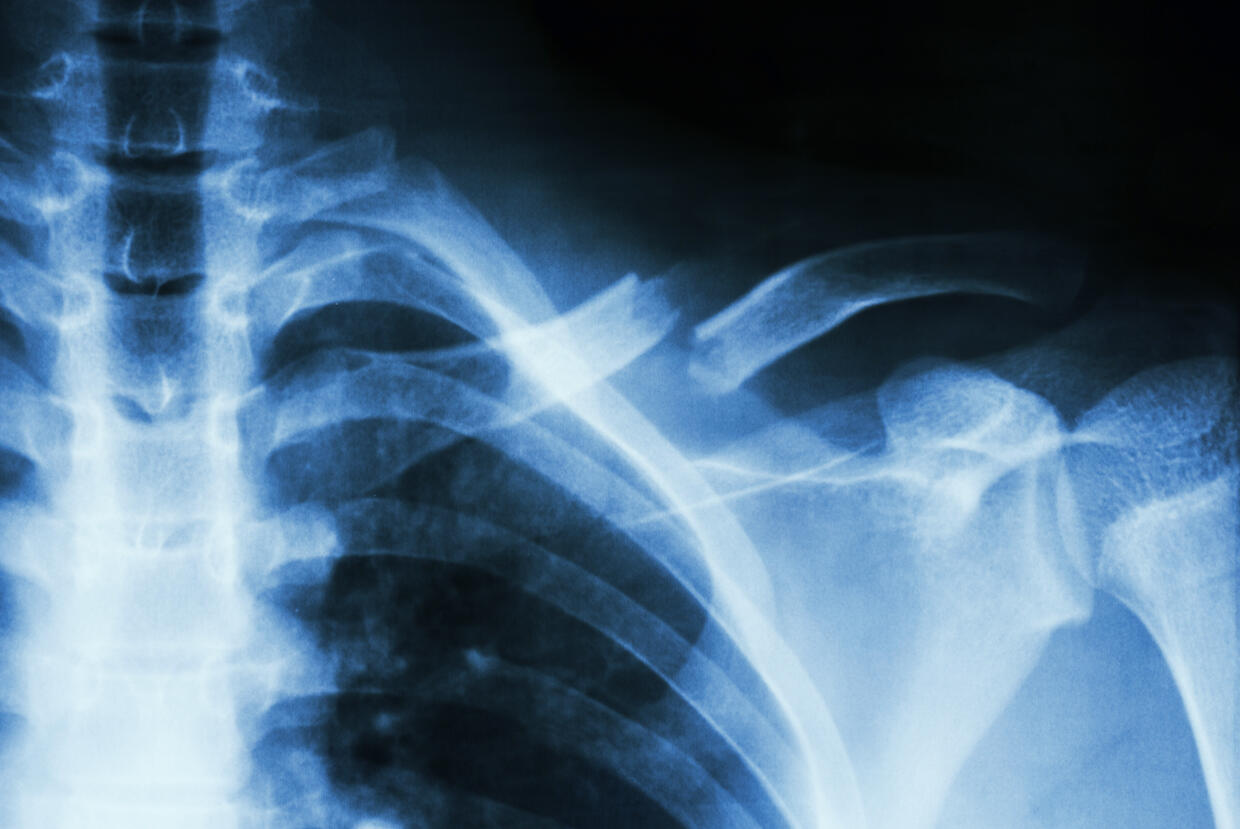 Image of an x-ray of a ribcage.