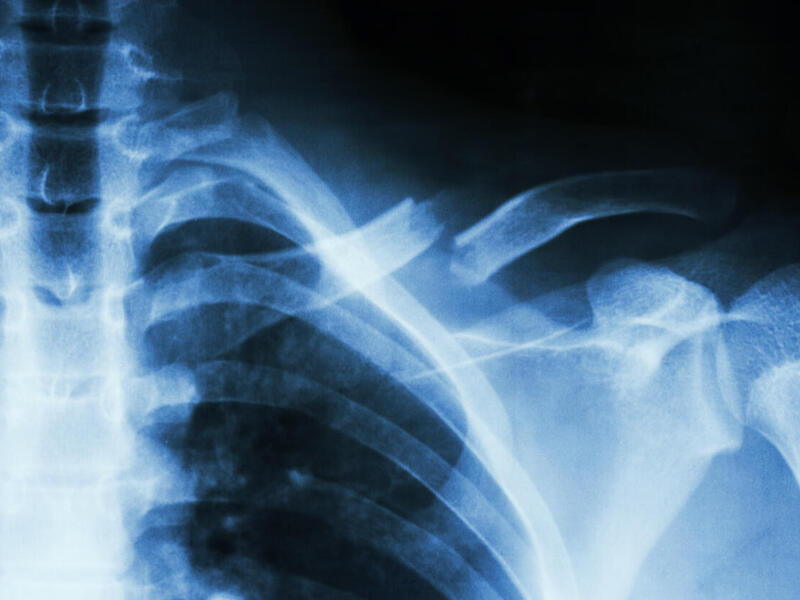 Image of an x-ray of a ribcage.