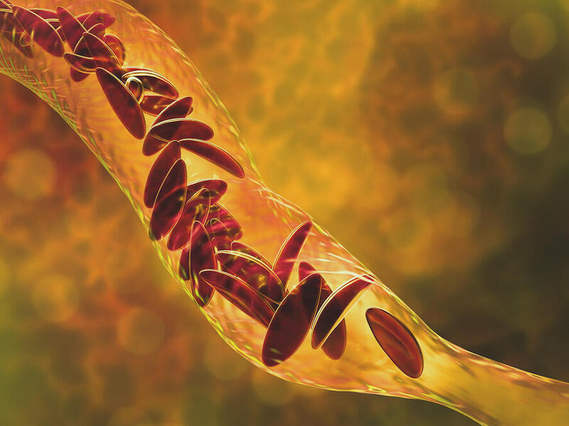 An illustration of sickle cells in blood vessel.