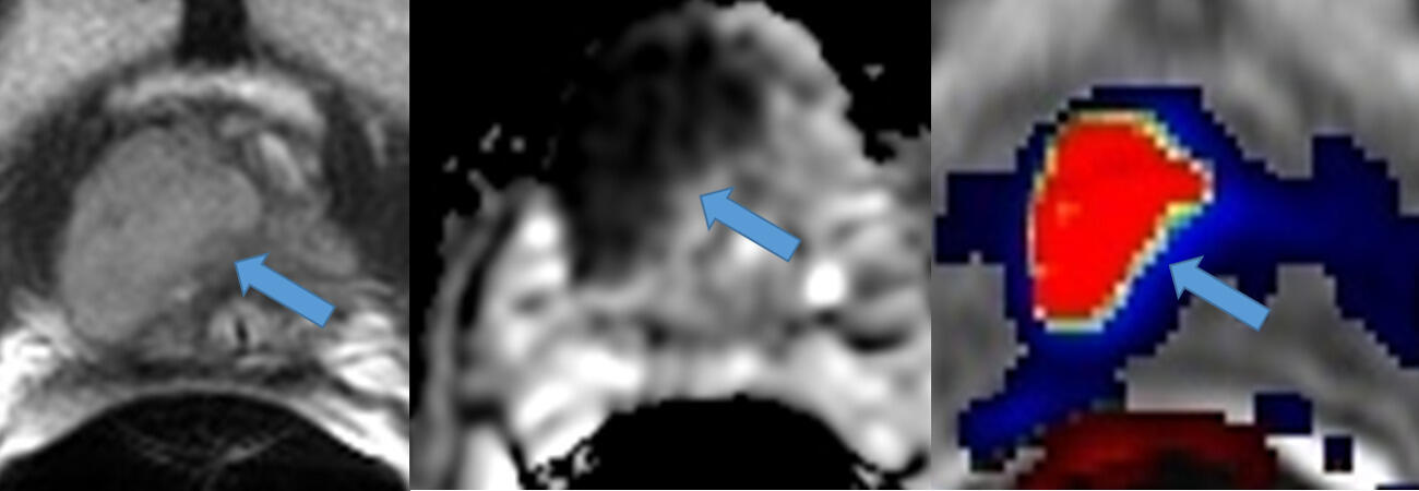 Prostate mp-MRI demonstrates a large tumor in the right apex indicated by the arrow. T2 weighted imaging (left) provides information of zonal anatomy and pathological processes of the prostate. Diffusion weighted imaging is sensitive to the changes at the cellular level. The cancer has a high cellularity that results in dark signal intensity. Dynamic contrast enhanced imaging provides a map of blood flow of the prostate tissue, which is increased in prostate cancer.